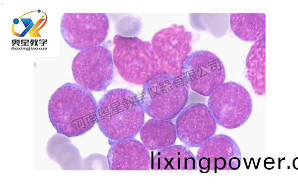 急性痳(lin)巴細(xi)胞(bao)白(bai)血(xue)病(bing)