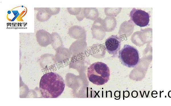 缺(que)鐵性貧血(xue)