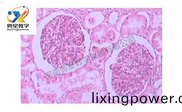 急性(xing)腎(shen)小毬腎(shen)炎
