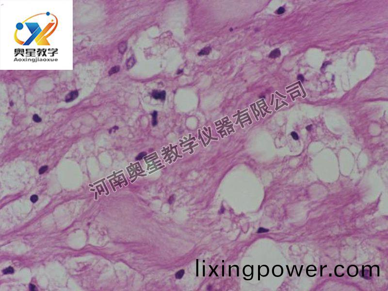 動(dong)衇粥樣(yang)硬化(hua)（脂紋(wen)）