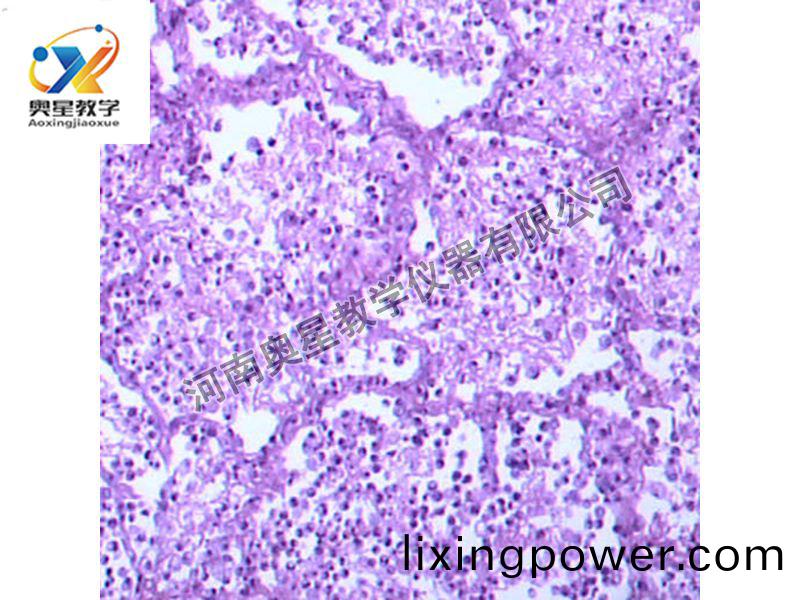 大(da)葉(ye)性(xing)肺炎(yan)(灰(hui)肝期)