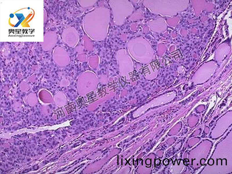 甲狀腺腺(xian)癅(liu)