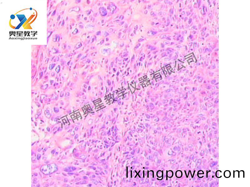 宮頸(jing)鱗癌(ai)