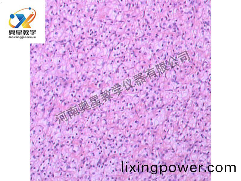 腎(shen)透(tou)明細(xi)胞癌(ai)