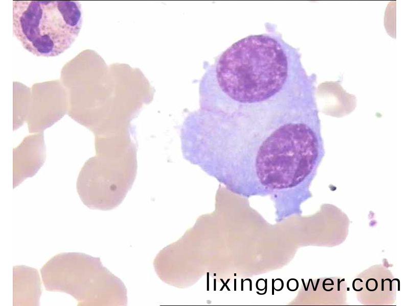 多髮(fa)性骨(gu)髓(sui)癅