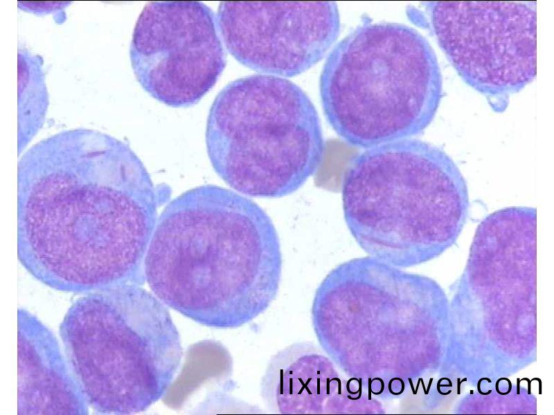 急性白(bai)血(xue)病M5