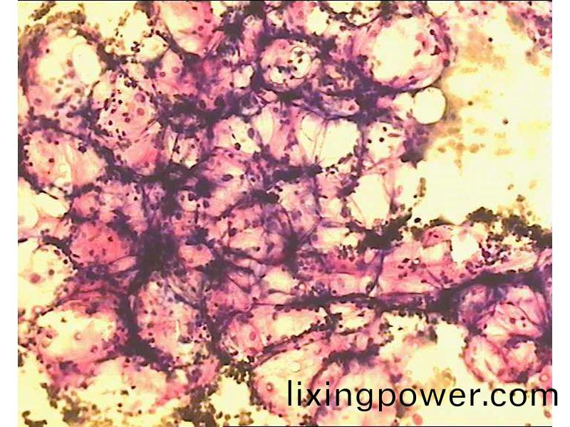 再生(sheng)障(zhang)礙性(xing)貧血